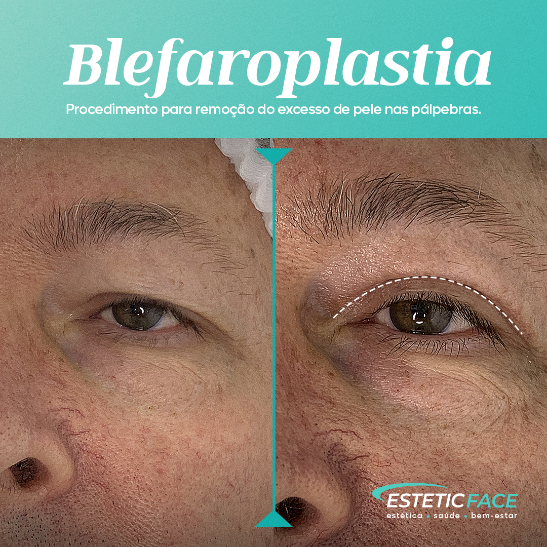 blefaroplastia