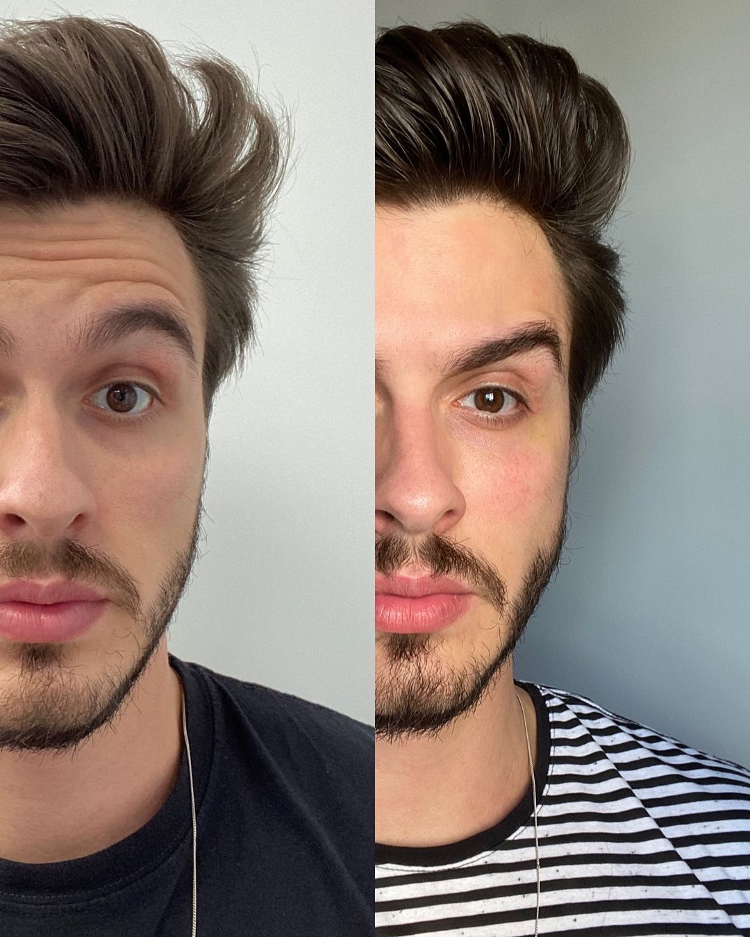 botox