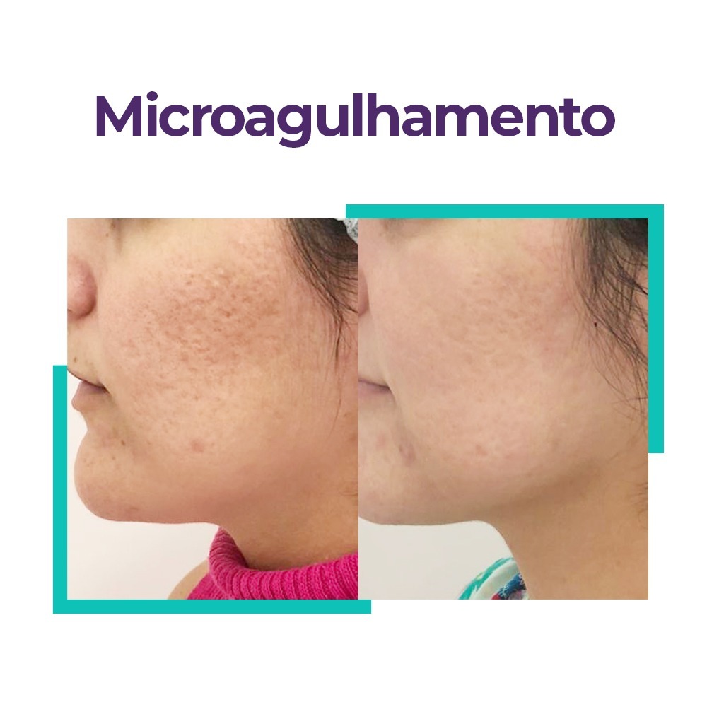 microagulhamento