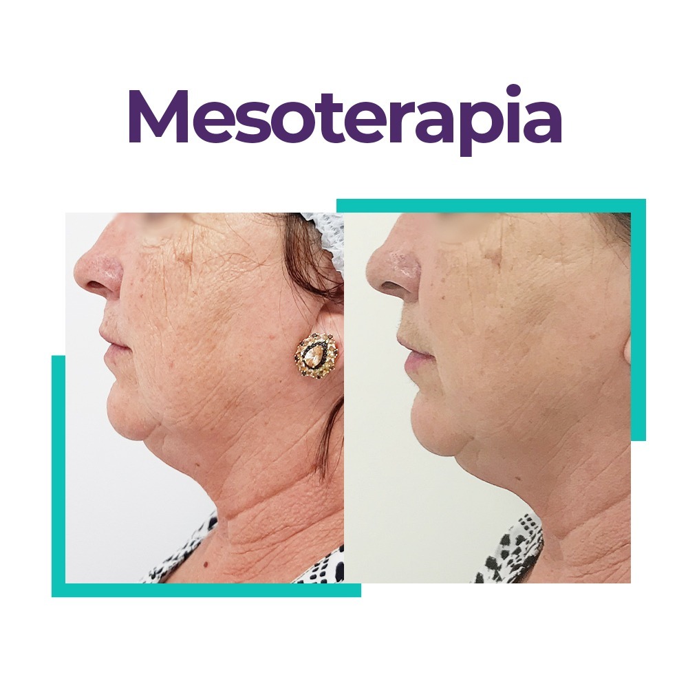 mesoterapia
