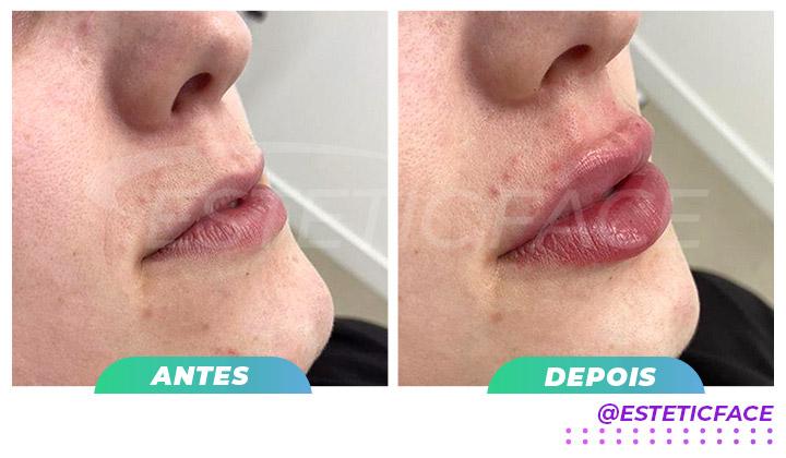 preenchimento labial