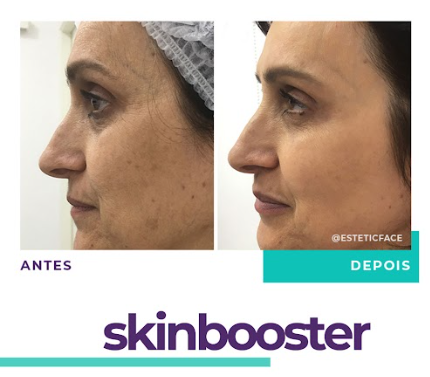 skinbooster